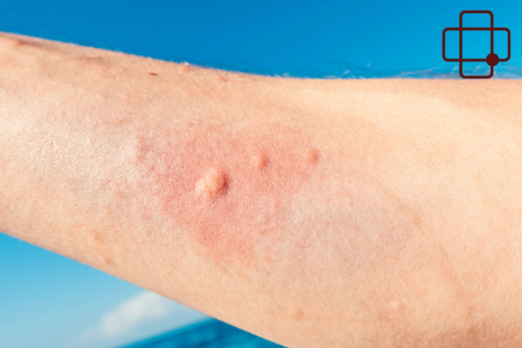 Sea Stings in Lombok_ What Families With Children and Elderly Travelers Should Know