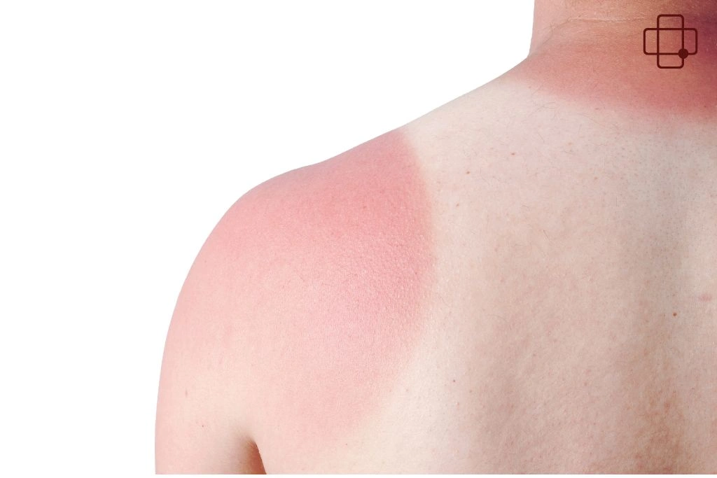 Understanding and Managing Sunburn in Lombok’s Tropical Paradise