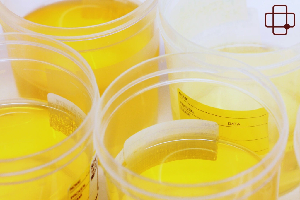 What Helps Restore Normal Urine Color While Traveling